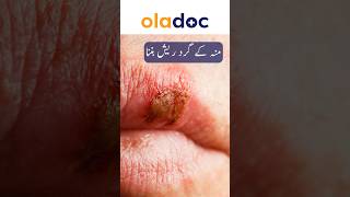 Facial Herpes How To Treat  Oral Herpes Prevention  Mouth Sores Ka Ilaj shorts youtubeshorts [upl. by Ialda]